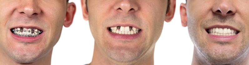 Po co zakłada się na zęby licówki? Z czego wykonane są licówki? Po co zakłada się na zęby licówki?