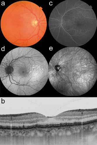 Charakterystyka druz z zastosowaniem współczesnych multimodalnych metod obrazowania siatkówki wać wzmożone przenikanie światła do naczyniówki, świadczące o uszkodzeniu RPE.