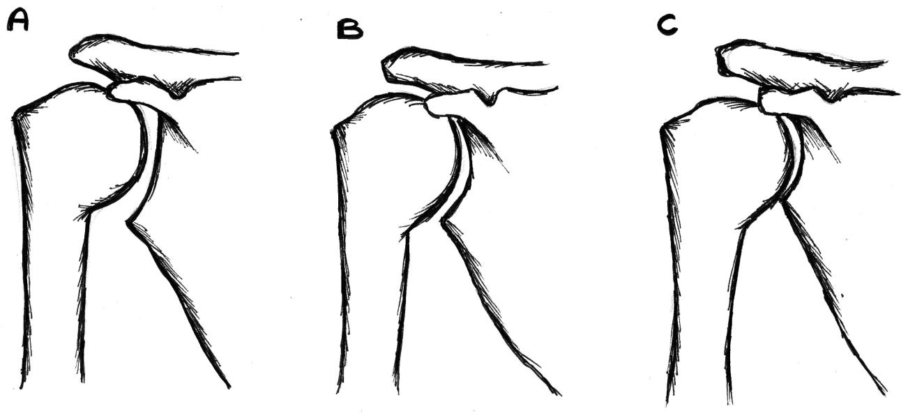 typ A powierzchnia stawowa głowy kości ramiennej ma promień krzywizny mniejszy od promienia krzywizny panewki łopatki typ B obie powierzchnie mają jednakowy promień krzywizny typ C promień krzywizny
