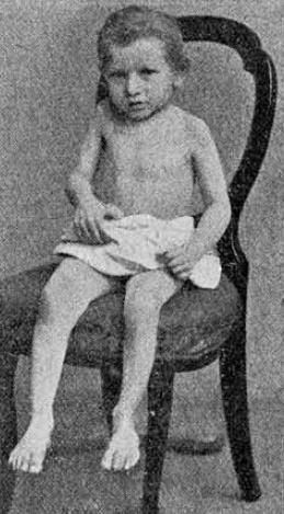 247. Marie Kaessler z Waldsassen ur. 1.stycznia 1893. Natychmiast po szczepieniu pojawiła się silna gorączka a po niej paraliż prawego szczepionego ramienia oraz lewej nogi.