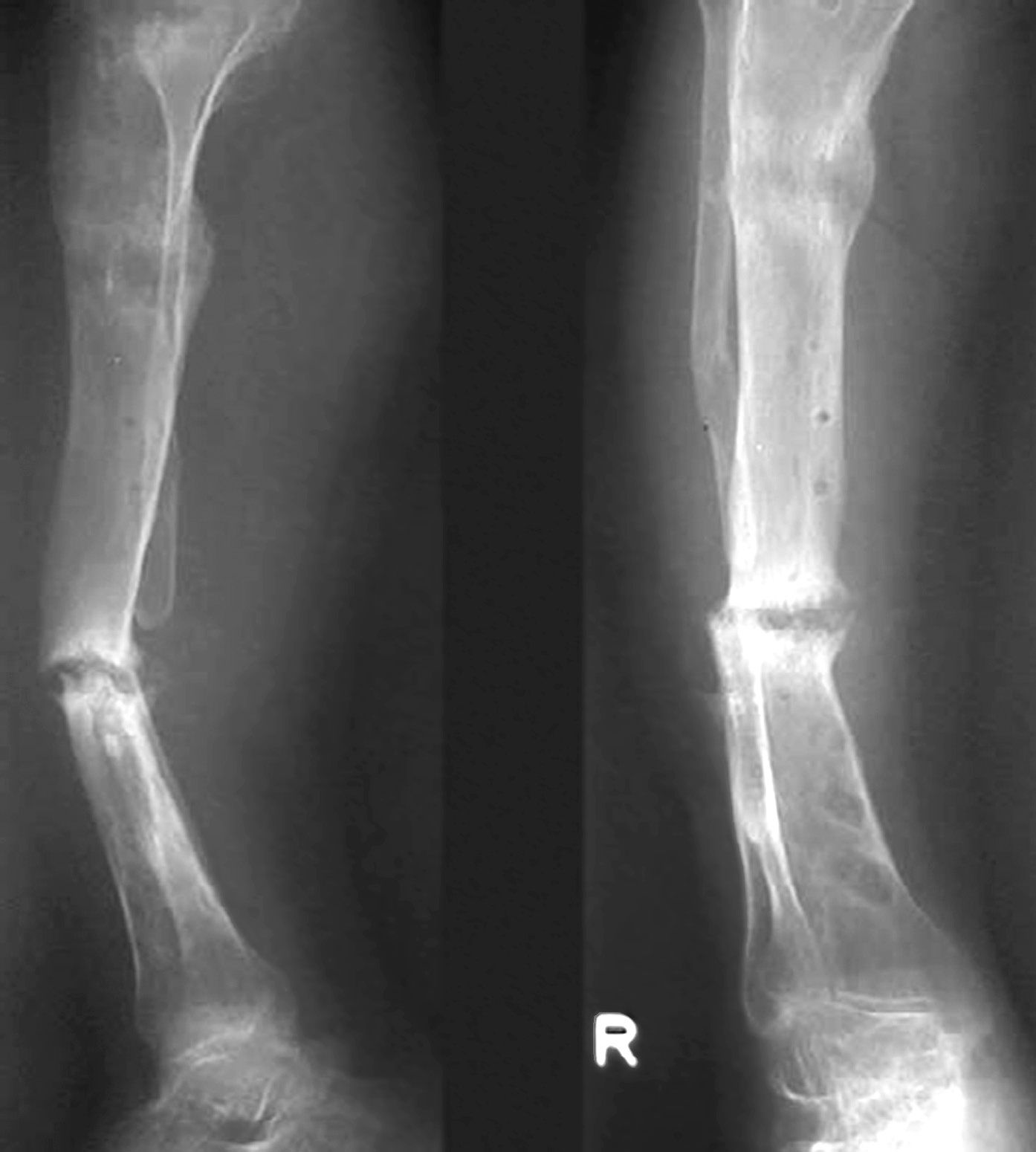 Regeneracja tkanki kostnej 63 Rycina 8.2. Staw rzekomy w miejscu złamania kości w obrazie rentgenowskim.