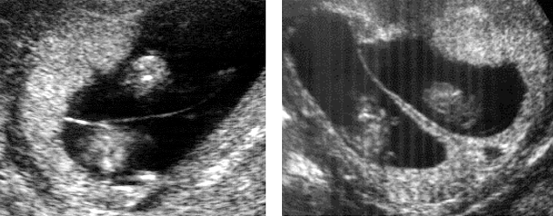 Fot. 1. Obraz ultrasonograficzny jednokosmówkowej (strona lewa) i dwukosmówkowej (prawa) ci¹ y bliÿniaczej w 12. tygodniu ci¹ y.
