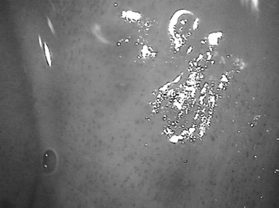 Mycosis of the uterine cervix 9 disordered and disorganized net (Fig.2).