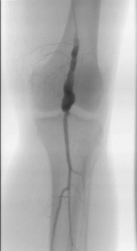 Tętniaki tętnic podkolanowych Zakrzepica lewej