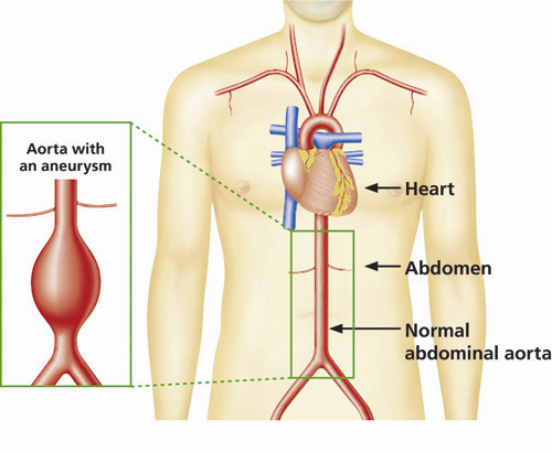 Polish translation of Abdominal aortic aneurysm screening: Things you need to know Badanie przesiewowe na obecność tętniaka aorty brzusznej (AAA) Co powinieneś wiedzieć Dla kogo przeznaczona jest ta
