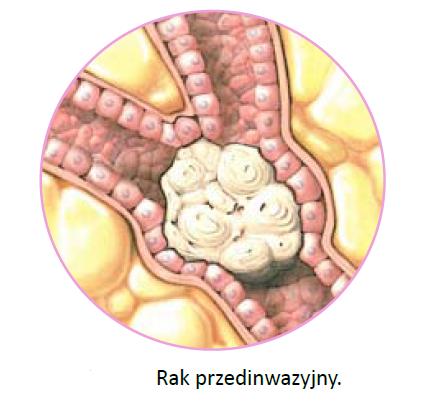 przewodowy zrazikowy LCIS