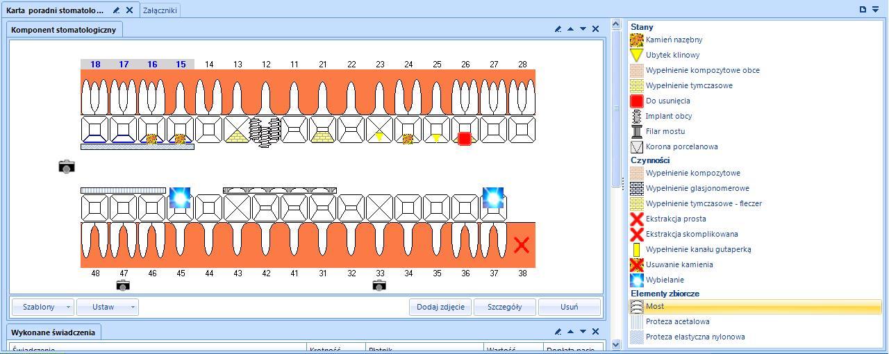 Usuwanie zaznaczeń z diagramu wprowadzonych w trakcie bieżącej wizyty odbywa się poprzez zaznaczenie odpowiedniego obszaru na diagramie i kliknięcie przycisku Usuń znajdującego się pod diagramem.