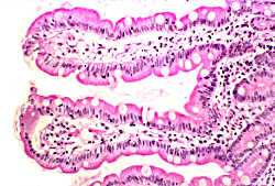 Choroba trzewna Celiakia Enteropatia