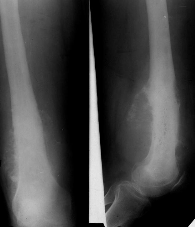 Mięsak kostny osteosarcoma młodzi chorzy 10-30 rok życia na granicy trzonu i
