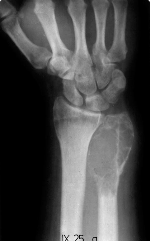 Guz olbrzymiokomórkowy osteoclastoma dorośli 20-40 rok życia nasady kości