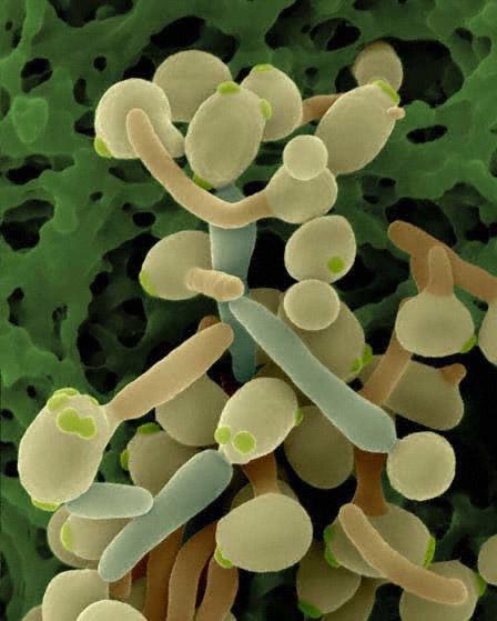 Kandydoza Przerost grzyba w jelitach > 10 5 Przerost Candida albicans może