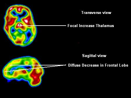 U osób depresyjnych zmianie ulega funkcjonowanie mózgu: - wzrost aktywności: - prawej okolicy przedczołowej - zakrętu obręczy - środkowej części wzgórza -