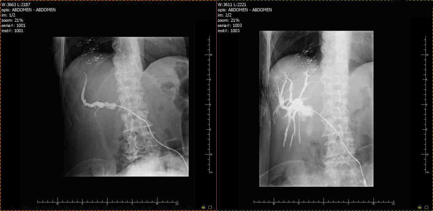 Rycina 10 Zmiany poziomu bilirubiny we krwi, zależnie od ilości drenowanej żółci. Changes in the level of bilirubin in the blood, depending on the amount of bile drained.
