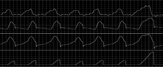 P di (cmh 2 