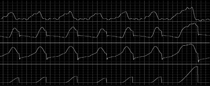 P di (cmh 2 O) 2 3 PAV P aw (cmh 2 O) Flow (l/sec) 1.2 Volume (l).