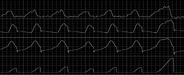 P di (cmh 2 O) P aw (cmh 2 O) Flow (l/sec) 2 3 1.2 PAV Volume (l).