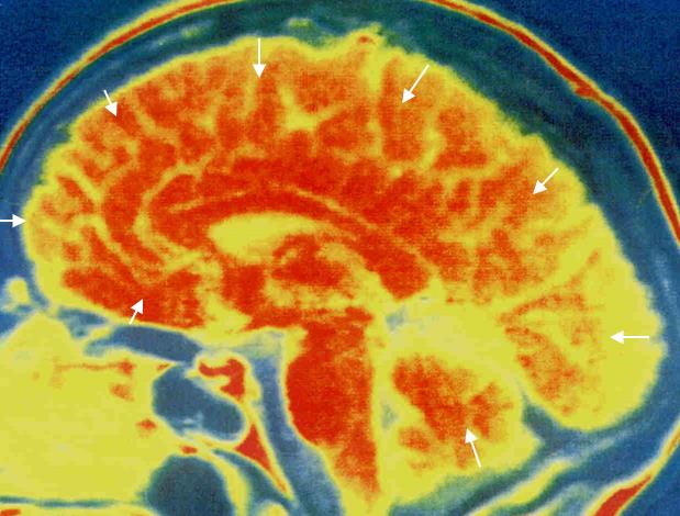 HIPONATREMIA: objawy Objawy - głównie neurologiczne związane ze