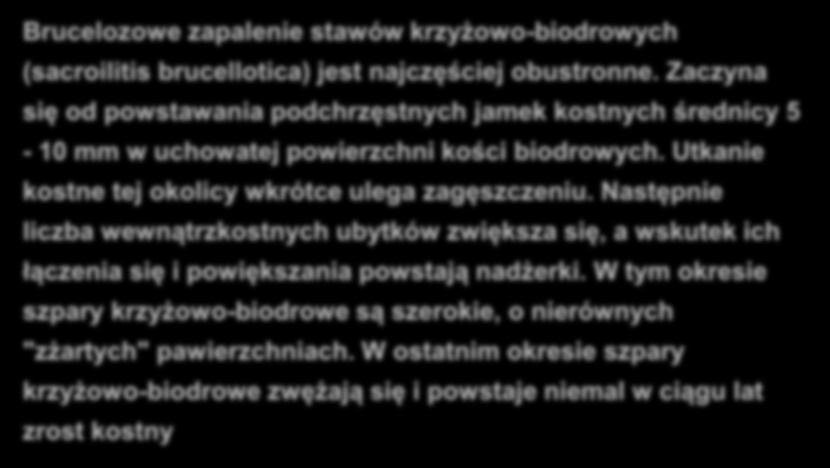 BRUCELOZA NARZĄDU RUCHU Brucelozowe zapalenie stawów krzyżowo-biodrowych (sacroilitis brucellotica) jest najczęściej obustronne.
