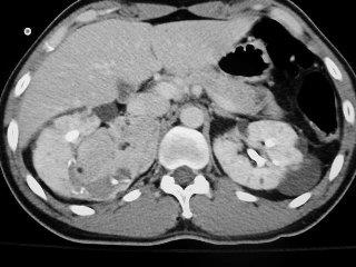 Angiomiolipoma TK Guz lity z zawartością tkanki tłuszczowej łagodne