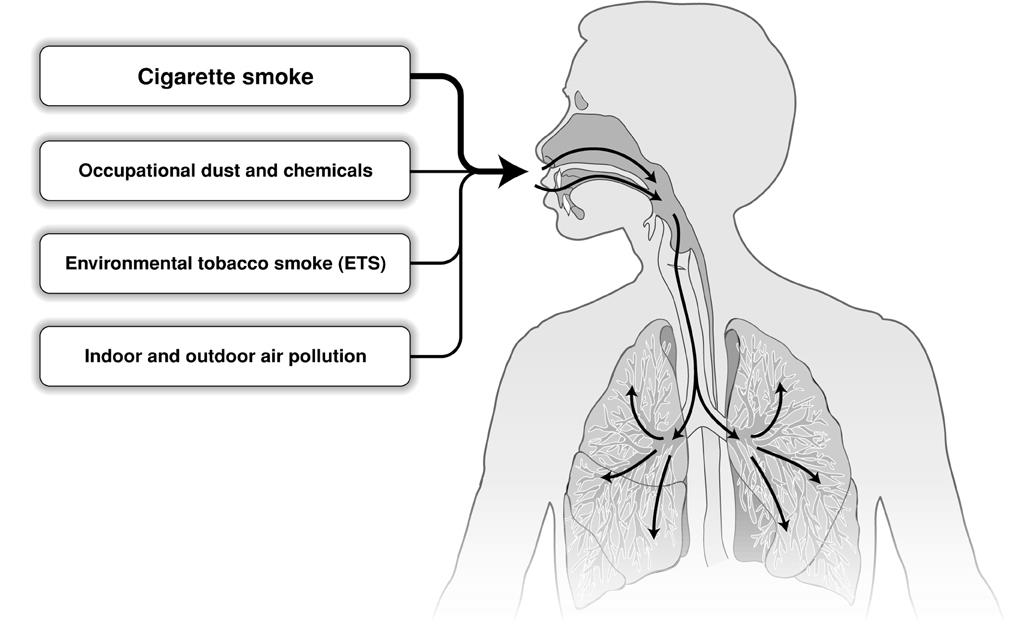 Global Strategy for Diagnosis, Management and Prevention of COPD 2015