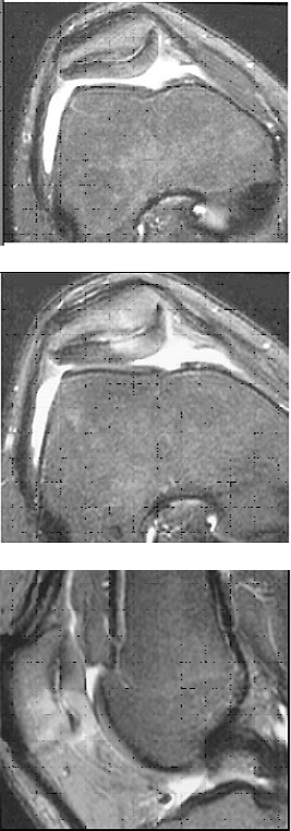 MRI przedstawiające nieprawidłowości rzepki rowerzysty. Dzięki uprzejmości Duke University Medical Center, Musculoskeletal Division, Durham, NC.