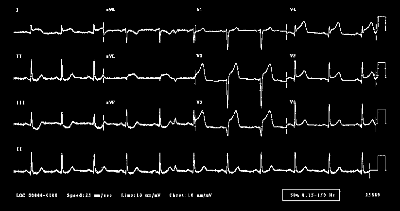 OZW z