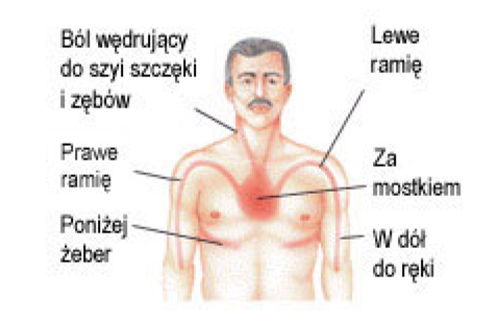 OBJAWY CHOROBY WIEŃCOWEJ Do objawów choroby wieńcowej, charakterystycznych zarówno dla kobiet, jak i mężczyzn należą: dolegliwości dławicowe - bóle w klatce