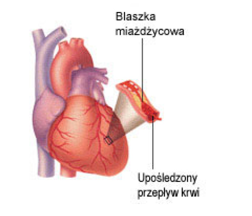 CHOROBA WIEŃCOWA - PRZYCZYNY Choroba wieńcowa jest wynikiem uszkodzenia wewnętrznej warstwy tętnic.