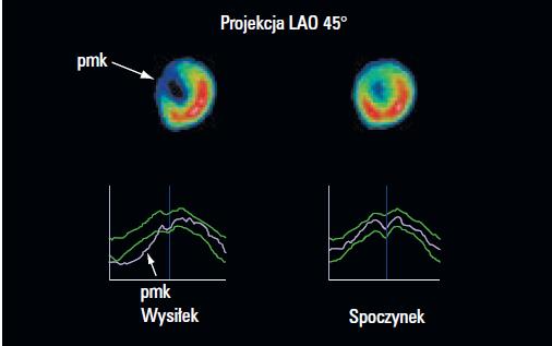 Białe strzałki na dwóch rysunkach powyżej przedstawiają ubytki perfuzji w mapie biegunowej, który spowodowany był niedokrwieniem mięśnia sercowego. Na rys.5.