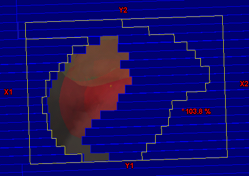 Intensity modulated radiation tcherapy - radioterapia z modulacją intensywności wiązki. Kształt pola napromieniania zmienia się w trakcie seansu przez ruch listków kolimatora wielolistkowego /MLC/.