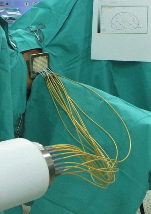 Radioterapia