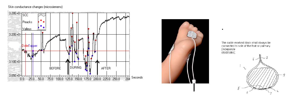 Skin Conductance Algesimeter Jest to metoda obiektywnej oceny natężenia bólu (stresu bólowego) metodą pomiaru fluktuacji przewodnictwa skórnego SCA (Skin Conductance Algesimeter) jako miary