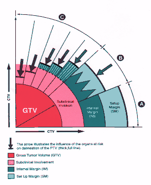 Kwantyfikacja obszaru napromieniania 1. GTV (gross tumor volume): obszar litego guza określonego w trakcie badań diagnostycznych 2.