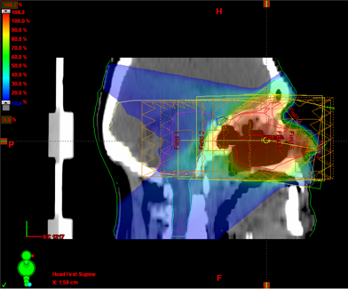 3D conformal IMRT