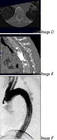 Wskazania dla MRI Przesuwając się dalej od złamań, MRI jest najlepsze w przypadku badania pacjenta z mielopatią, powodowaną urazem kręgosłupa, tak jak przepuklina dyskowa albo nieprawidłowości