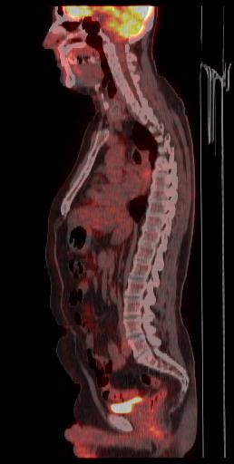 od podejścia one size fits all From one size fits all to personalized do personalizowanej radioterapii therapy 18 FDG PET-CT przed 89 Zr-rituximab przed 89 Zr emiter