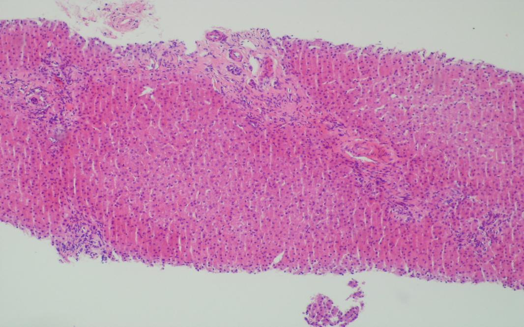 cytokeratyna 7, W poszerzonych przestrzeniach