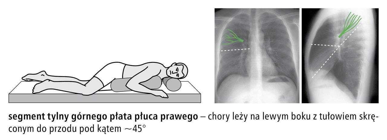Segment tylny górny płat płuca