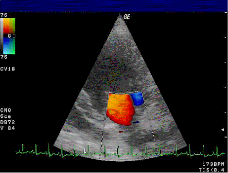 Ultrasonografia dopplerowska Badanie zastawki mitralnej Opiera się na efekcie Dopplera;