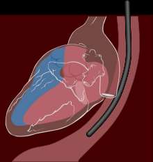 Korzyści podczas zabiegu operacyjnego nie ma dostępu do ściany klatki piersiowej obraz uzyskiwany w