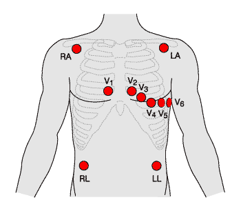 Niestandardowe odprowadzenia EKG Układ Mason-Likar wykorzystywany w rejestracji ambulatoryjnej i elektrokardiograficznej próbie wysiłkowej Ograniczenie: możliwość