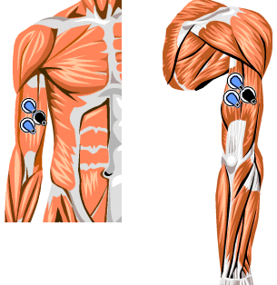 Możliwości wykorzystania sygnału EMG do sterowania. 111 Rys. 1. Rozmieszczenie elektrod. Z lewej: m. biceps brachii, z prawej: m. triceps brachii (źródło: dokumentacja firmy Biomation) 2.