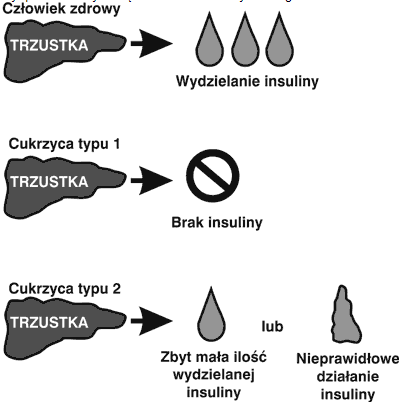 Insulinooporność jest brakiem