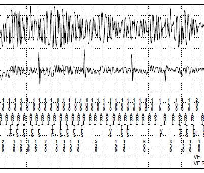 1 2 3 4 Pozasercowe: Uszkodzenie elektrody kardiowerteradefibrylatora Interferencje Zakłócenia elektromagnetyczne elektromagnetyczne 50Hz. Wyczuwanie potencjałów mięśniowych kanale przedsionkowym. np.