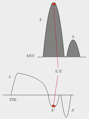 Porównanie prędkości fali wczesnego napływu mitralnego (E ) z E / E