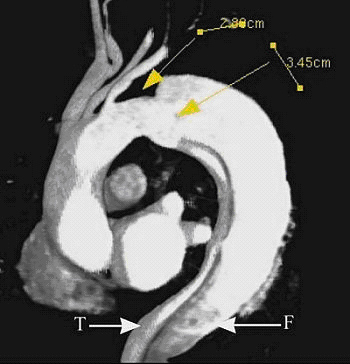 Wrota pierwotne w typie Stanford B i ich stosunek do lewej tętnicy podobojczykowej (powyżej, obydwa VR).