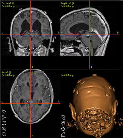 Nawigacja optyczna- skrzyżowane linie na przekroju MRI wskazują zakończenie narzędzia chirurgicznego.