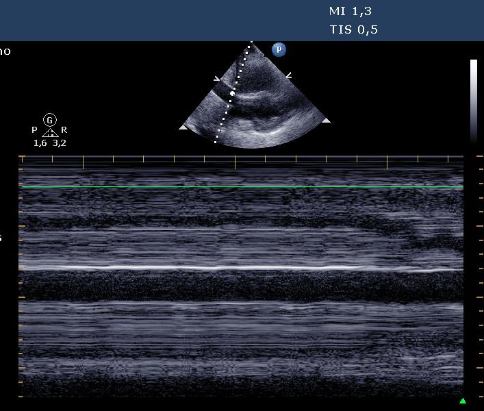 tank: IVC