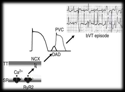 CPVT RyR2 - gain of function (domin.): CPVT1 Wysokie ryzyko nagłego zgonu (30-50% przed 20-30 r.ż.