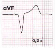 Przemieszczenie poniżej linii izoelektrycznej 0,5mm Poziome Niedokrwienie lub zawał przedsionka Zapalenie osierdzia Skośne do dołu (zwykle skojarzone z obniżeniem J) Przerost i